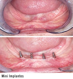 Mini implantes