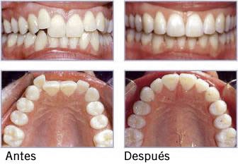 Teeth-straightening-wihout-braces11