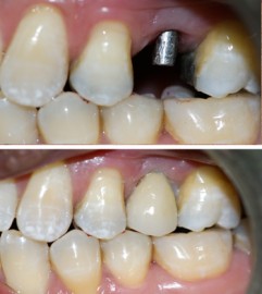 Implante posterior