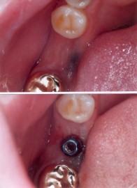 Implante Posterior Oclusal