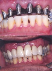 Implantes de Función Inmediata